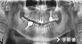 基隆牙醫、基隆牙醫價錢、基隆 植牙、基隆 矯正 推薦、基隆矯正推薦、基隆植牙