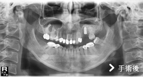 基隆牙醫、基隆牙醫價錢、基隆 植牙、基隆 矯正 推薦、基隆矯正推薦、基隆植牙