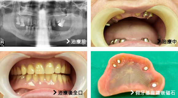 基隆牙醫、基隆牙醫價錢、基隆 植牙、基隆 矯正 推薦、基隆矯正推薦、基隆植牙
