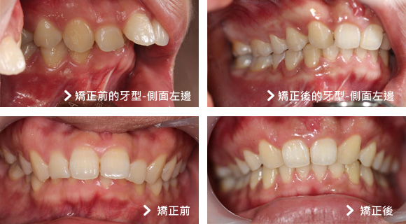 基隆牙醫、基隆牙醫價錢、基隆 植牙、基隆 矯正 推薦、基隆矯正推薦、基隆植牙