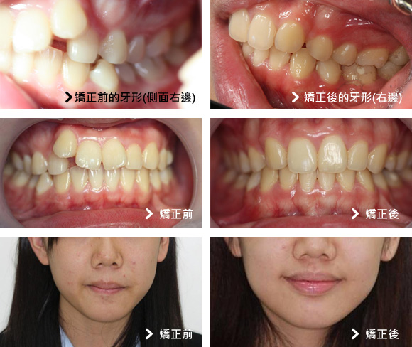 基隆牙醫、基隆牙醫價錢、基隆 植牙、基隆 矯正 推薦、基隆矯正推薦、基隆植牙