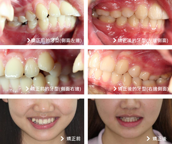 基隆牙醫、基隆牙醫價錢、基隆 植牙、基隆 矯正 推薦、基隆矯正推薦、基隆植牙